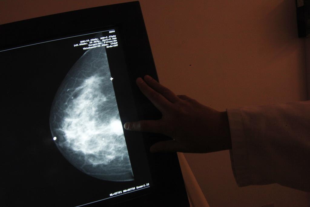 Cancro da mama. Foto: Edgard Garrido/Reuters