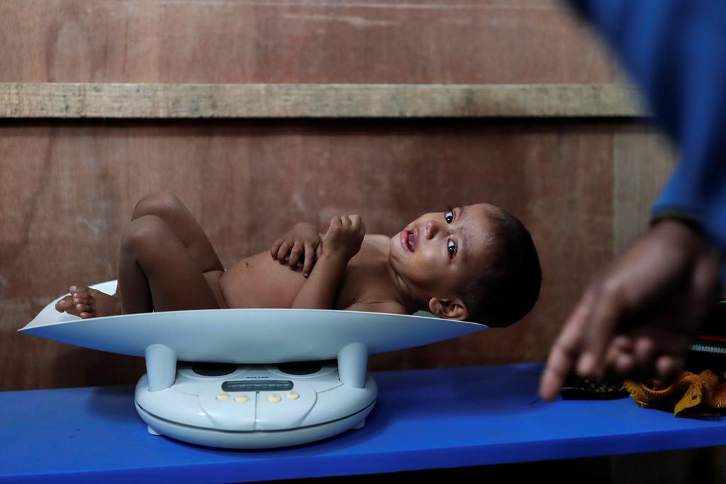 Criança da comunidade rohingya de Myanmar afetada por malnutrição. Foto: Tyrone Siu/Reuters (arquivo)