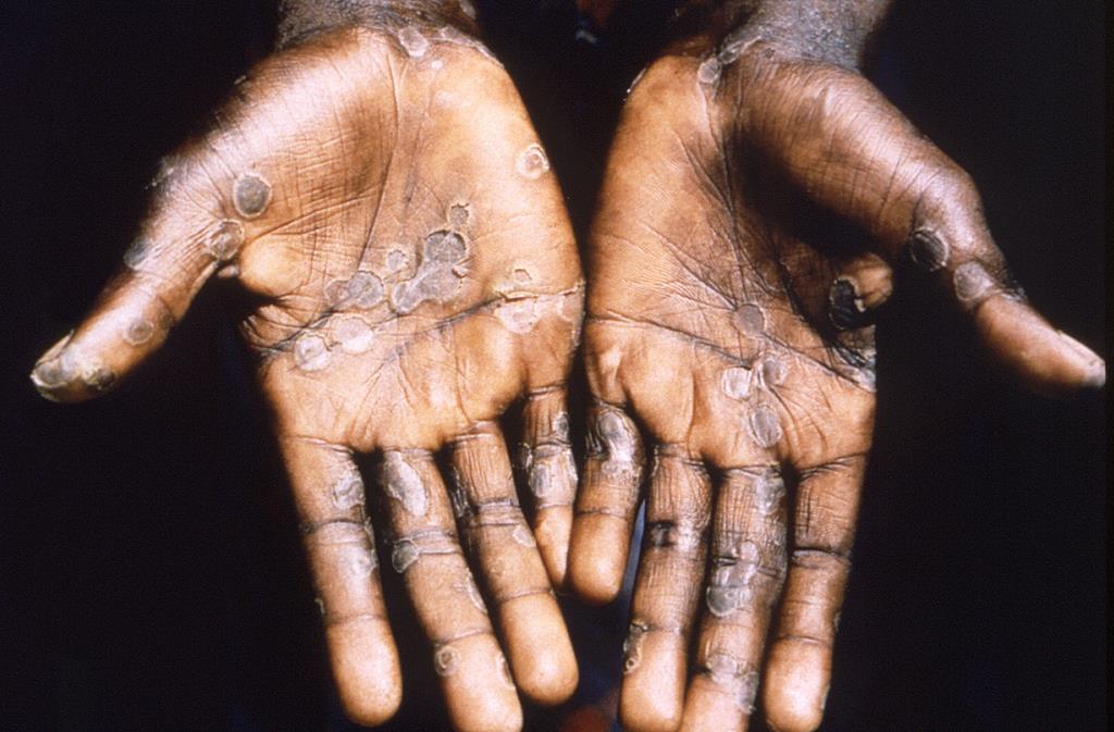Varíola dos macacos. Doente na cidade de Lodja, na República Democrática do Congo. Foto: Reuters