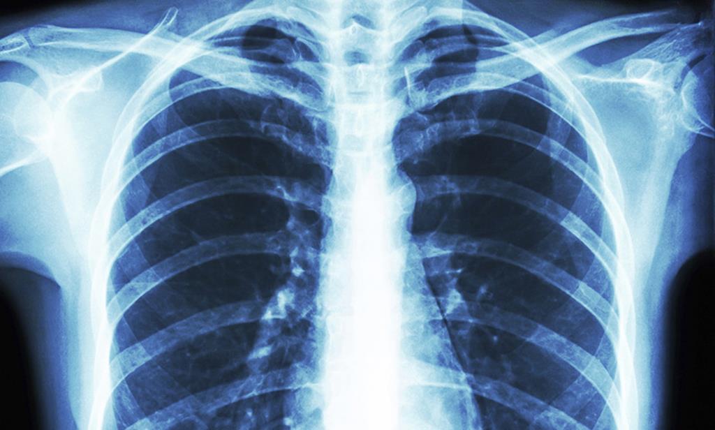 Pessoas com problemas respiratórios são particularmente sensíveis à Covid-19. Foto: DR